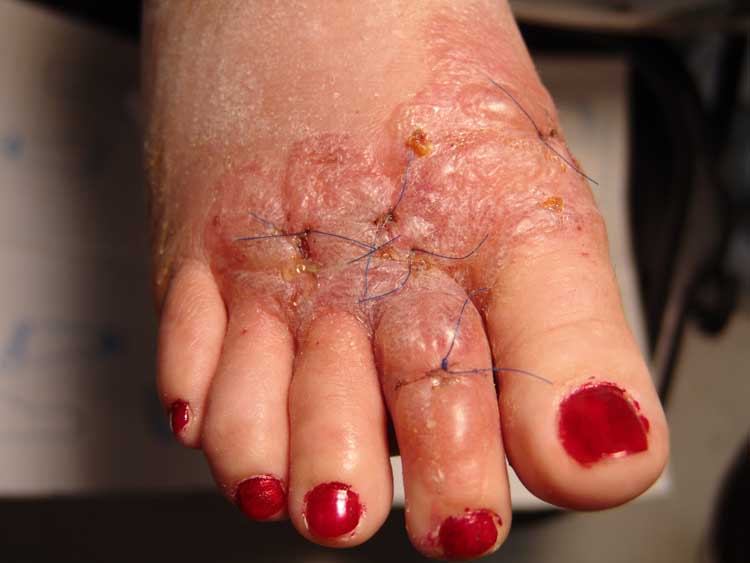 Allergic Contact Dermatitis of the Foot after use of Mastisol® Skin 
