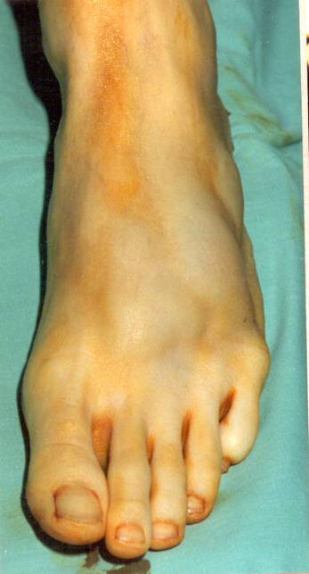 Figure 2 Massive left foot ganglion cyst to the dorsum of the foot.
