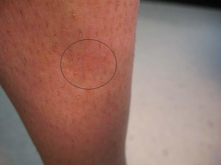 circle on arms and legs rash | Rash On Arms