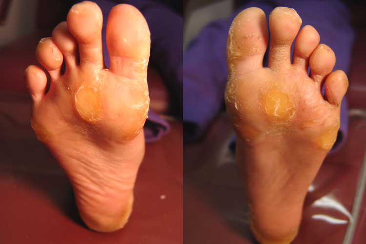  both feet with associated severe nail dystrophy to all fingers and toes.