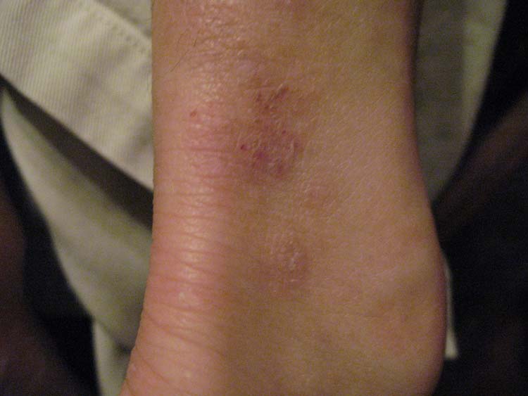 red rash on lower legs