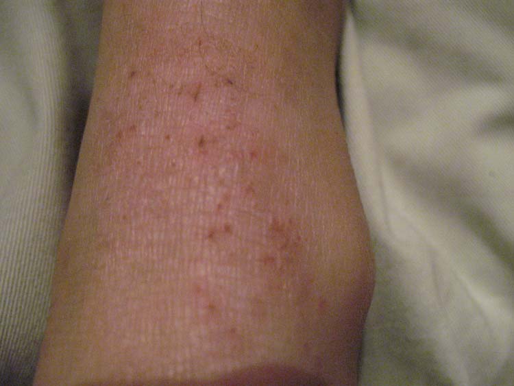 Red Spots on Legs | MedGuidance