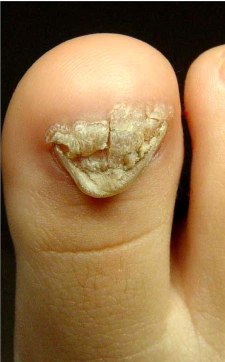 What Causes Warts on Feet and What You Can Do About Them