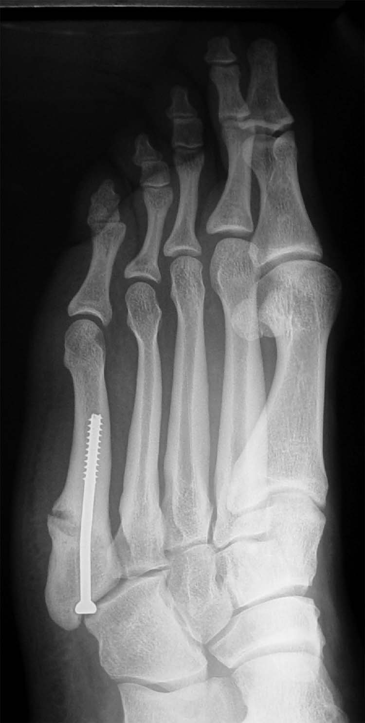 What are some reasons for stress fracture in the fifth metatarsal bone?